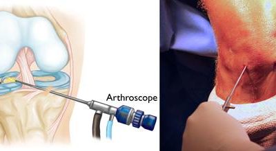 दुर्बिणीद्वारे गुडघ्यातील गादीची शस्त्रक्रिया