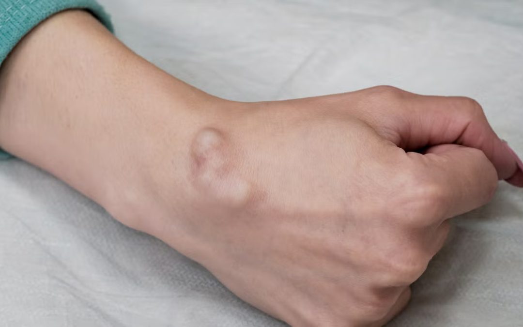 गॅन्ग्लियन सिस्ट म्हणजे काय?